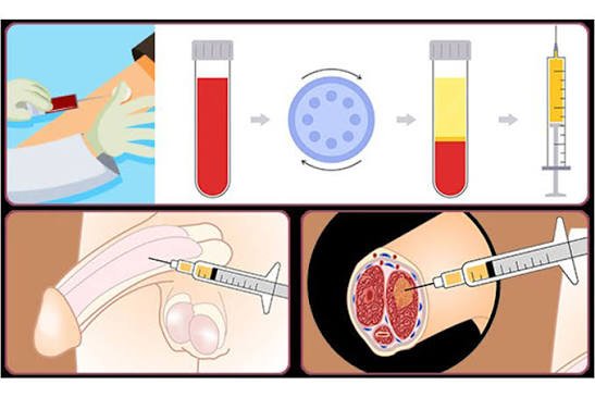 Priapus Shot Treatment In Itarsi