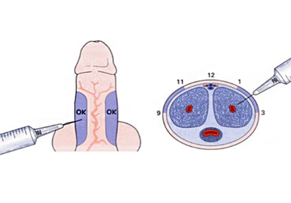 Priapus shot treatment in shahdol