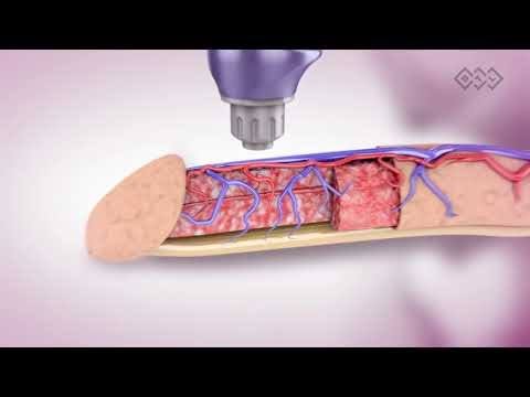 Shockwave Therapy for ED in Gadarwara