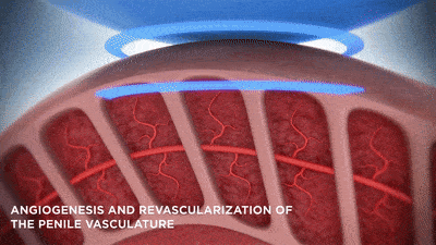 Shockwave Therapy for ED in Itarsi