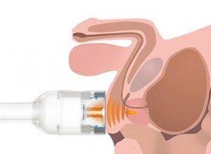 Shockwave Therapy for ED in Sagar