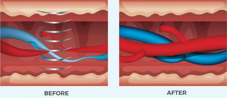 Shockwave Therapy for ED in Yavatmal